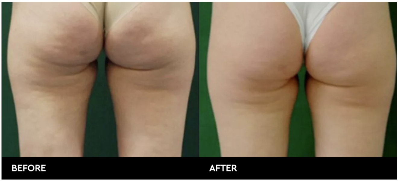 Cellulite removal treatment Aesthetics labs